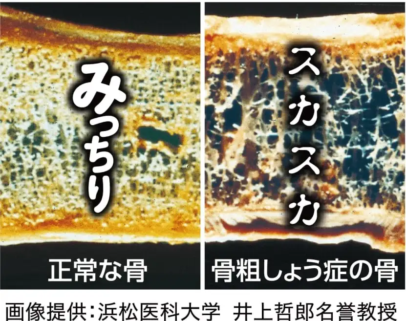正常な骨と骨粗しょう症の骨比較