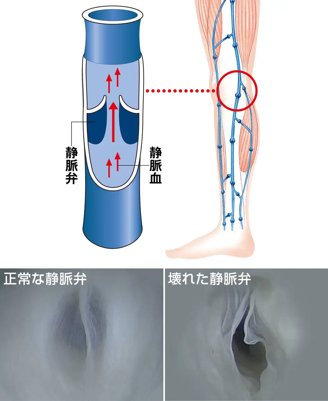 通販生活®ギロファ・コンプレッソフィクスII（就寝用）｜【公式 