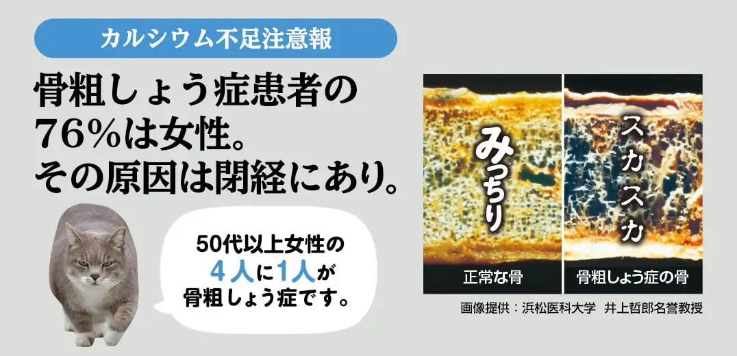 カルシウム不足注意報 骨粗しょう症患者の76％は女性。その原因は閉経にあり。50代以上女性の４人に1人が骨粗しょう症です。