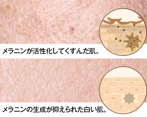 メラニンが活性化してくすんだ肌とメラニンの生成が抑えられた白い肌の比較