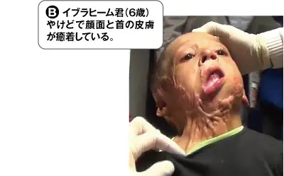 B・イブラヒーム君(6歳)。やけどで顔面と首の皮膚が癒着している。