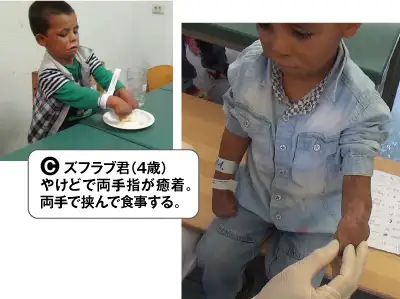 C・ズフラブ君(4歳)。やけどで両手指が癒着。両手で挟んで食事する。