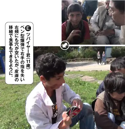 E・ツバイヤー君(11歳)。ペン型爆弾で右手の指を失い右頬にも穴が空いたが、皮膚の移植で食事もできるように。