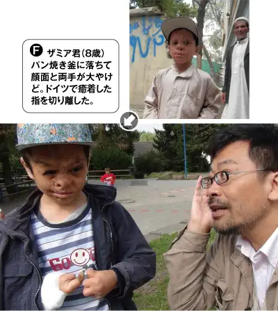 F・ザミア君(8歳)パン焼き釜に落ちて顔面と両手を大やけど。ドイツで癒着した指を切り離した。