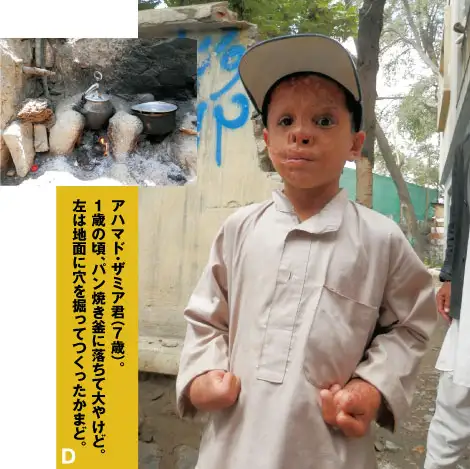 アハマド・ザミア君（7歳）。1歳の頃、パン焼き釜に落ちて大やけど。左は地面に穴を掘ってつくったかまど。