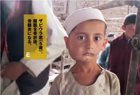 ザビウラ君（5歳）。顔面を骨折後、骨髄炎になる。