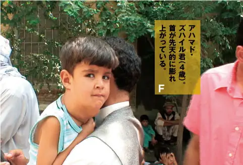 アハマド・ズマイル君（4歳）。首が先天的に膨れ上がっている。