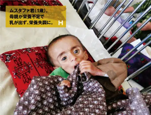 ムスタファ君（1歳）。母親が栄養不調で乳が出ず、栄養失調に。