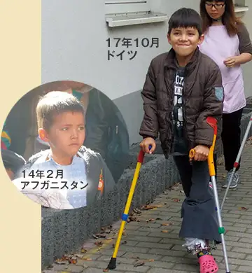 骨髄炎で足が変形した ダーニッシュくん(アフガニスタン・9歳)