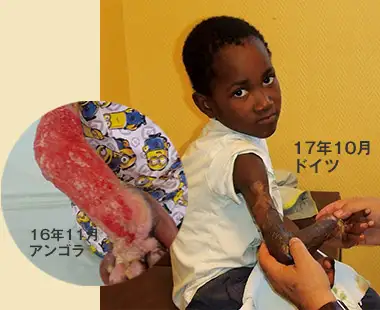 熱帯特有の潰瘍に侵された ガルシアくん(アンゴラ・7歳)