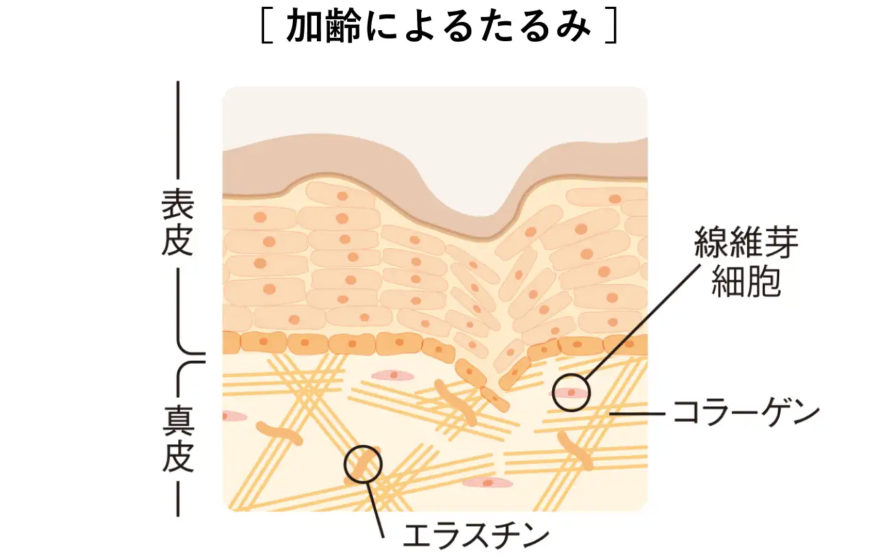 加齢によるたるみイメージ